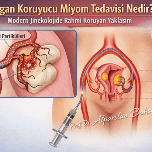Organ koruyucu miyom tedavisini gösteren tıbbi illüstrasyon, rahim ve damar yapısı üzerinde miyomların hedeflenmesi